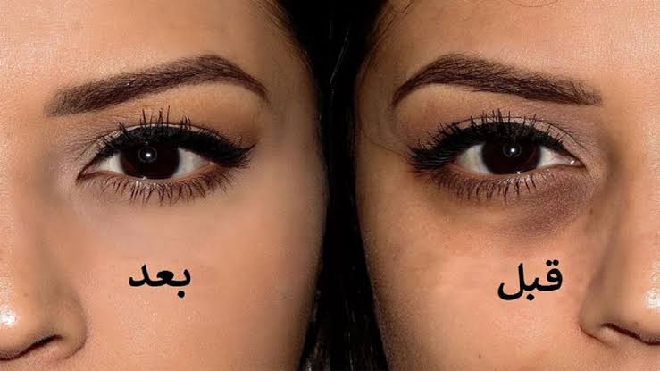 وصفات للتخلص من الهالات السوداء