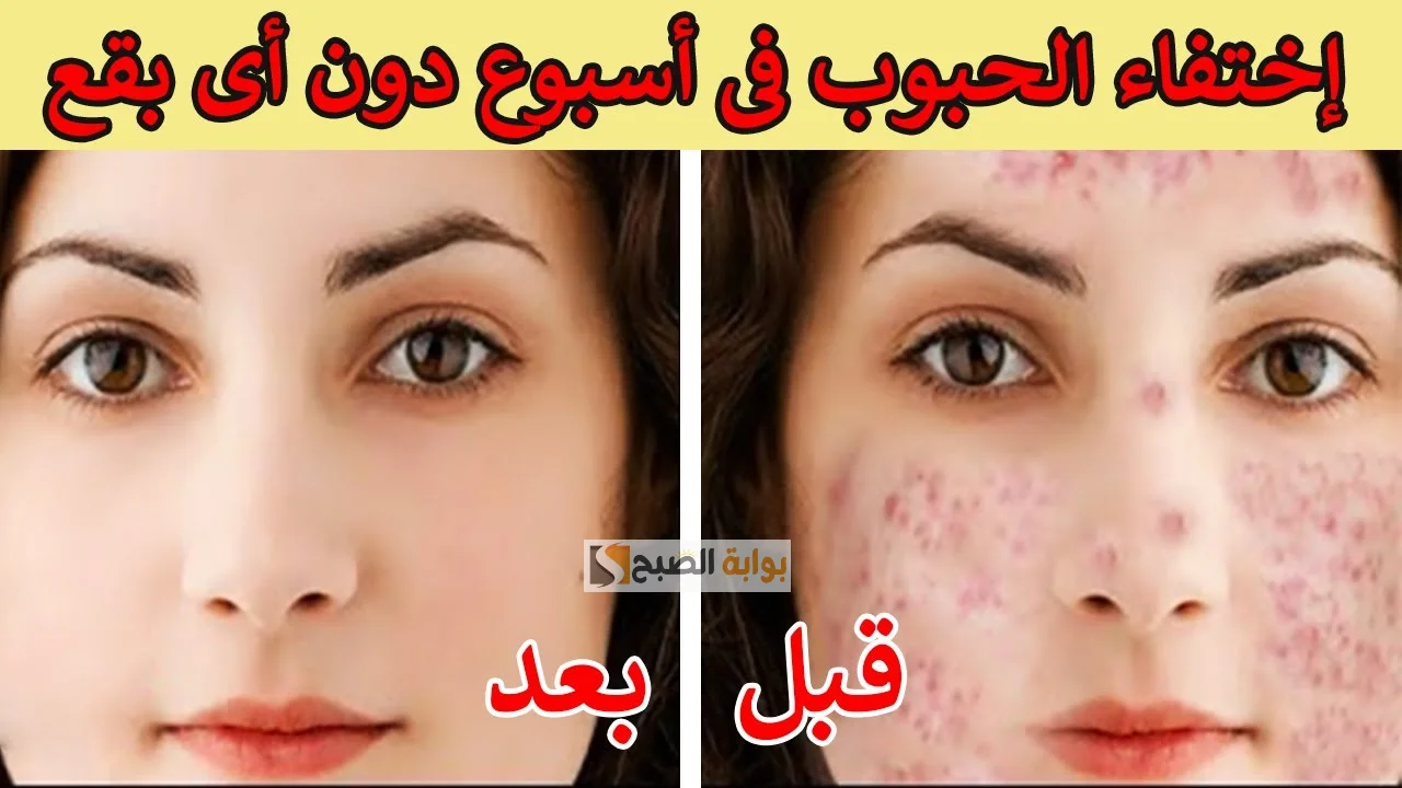 البيض للتخلص من حبوب الوجه