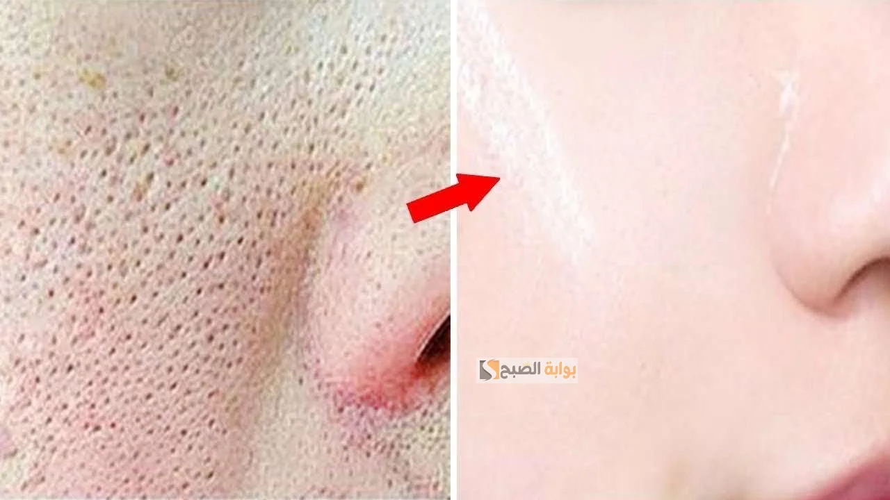 التخلص من المسام الواسعة