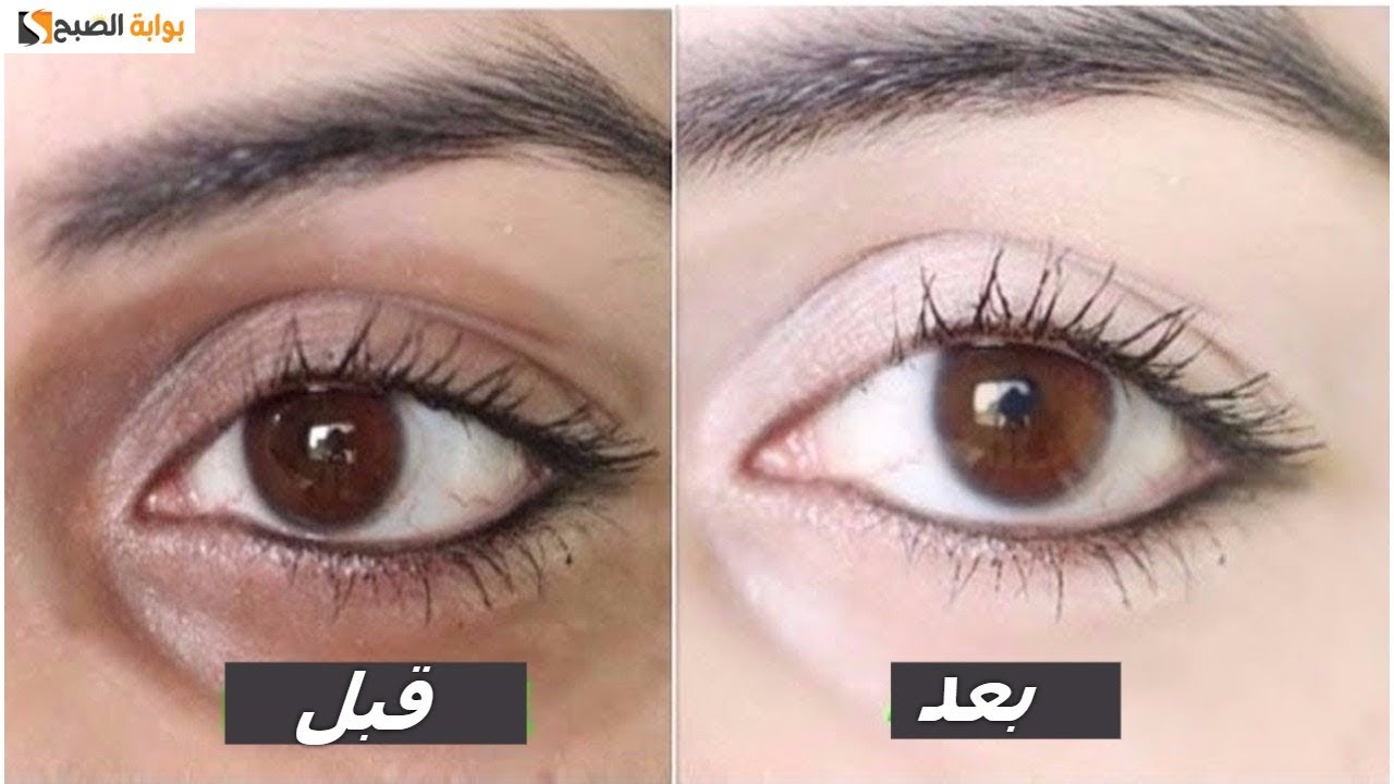 التخلص من الهالات تحت العين
