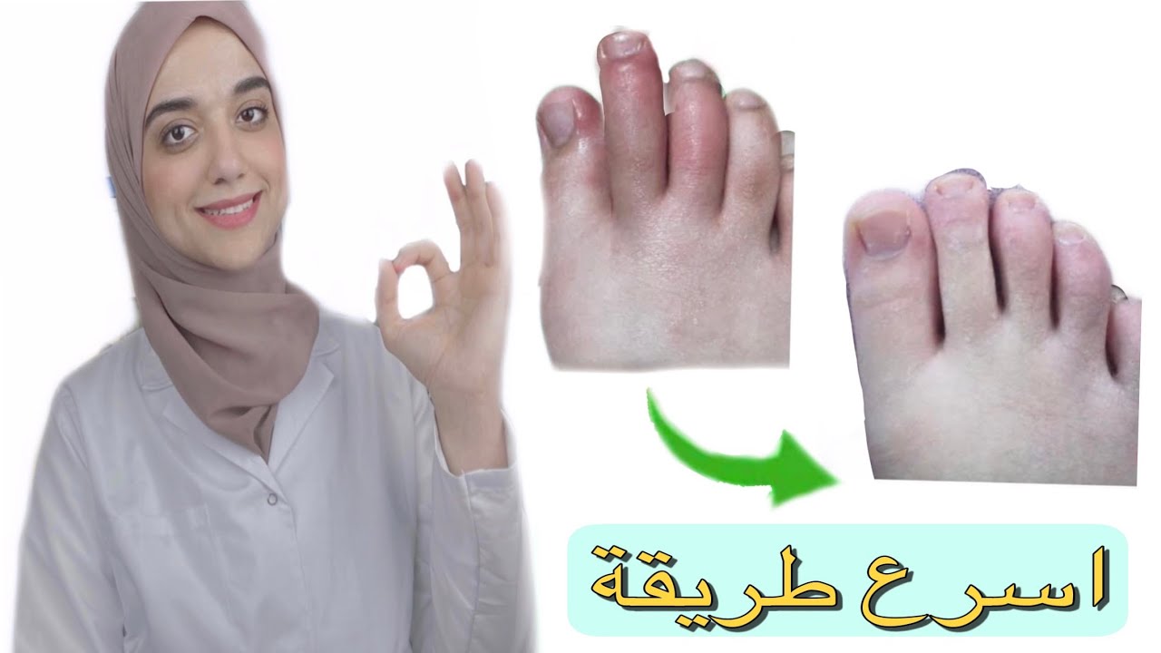التخلص من برودة الأطراف