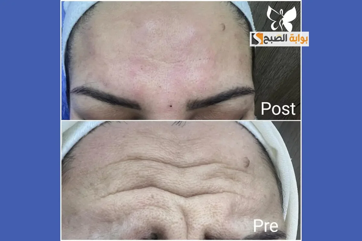 التخلص من تجاعيد الجبين