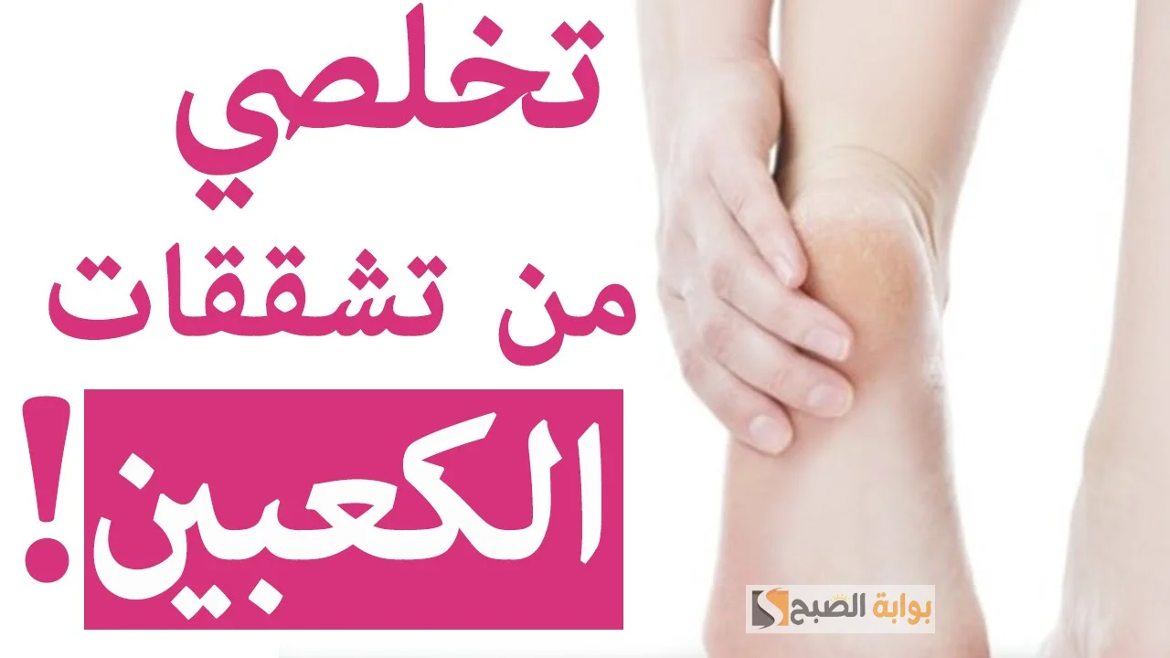 التخلص من تشققات الكعبين