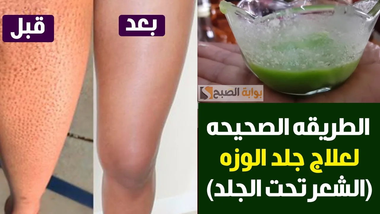 التخلص من جلد الوزة
