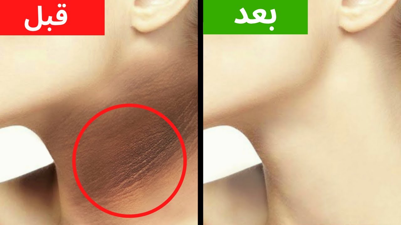 "وصفة سحرية" وصفة تبييض الرقبة في أقل من ربع ساعة وكل سواد رقبتك مش هتلاقيه خالص