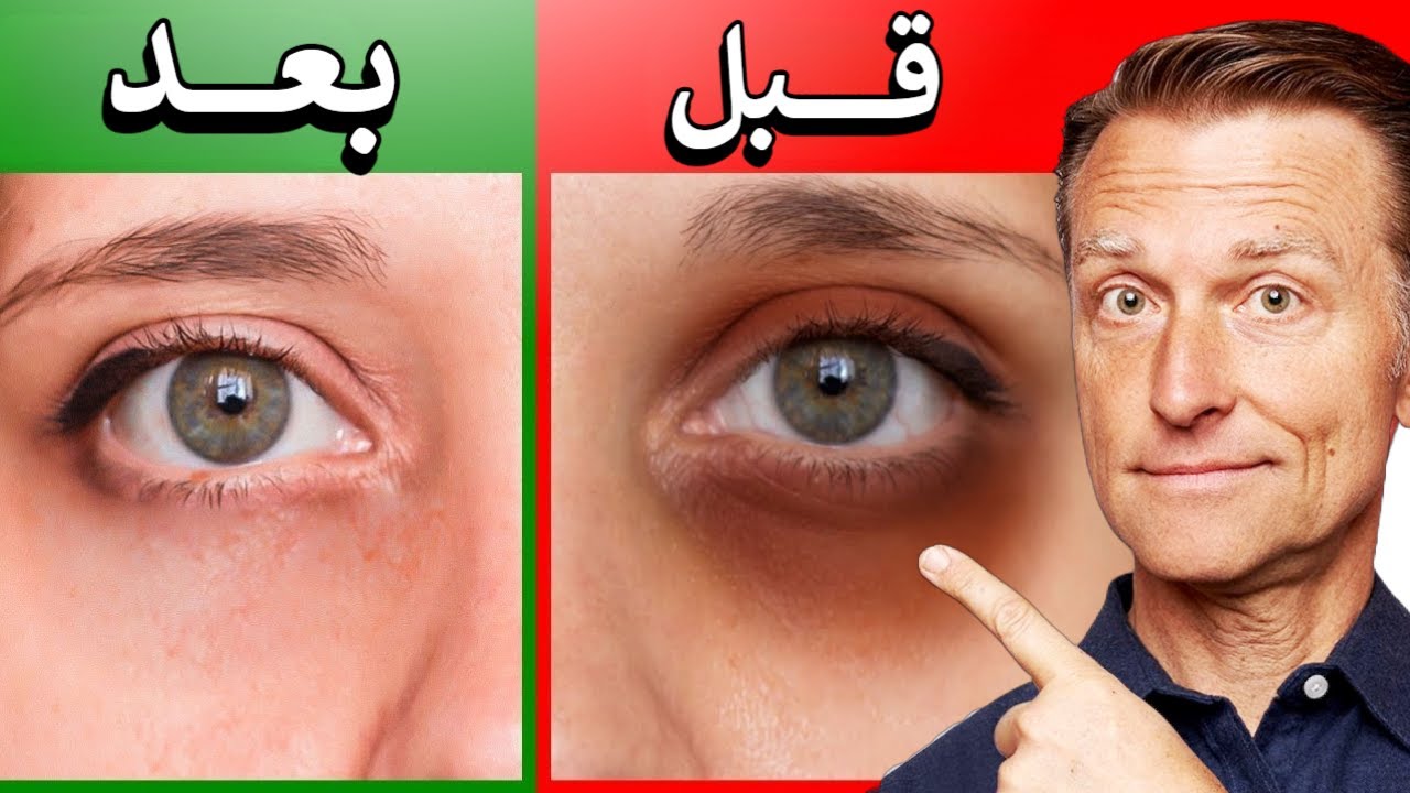 التخلص من الهالات السوداء بسرعة