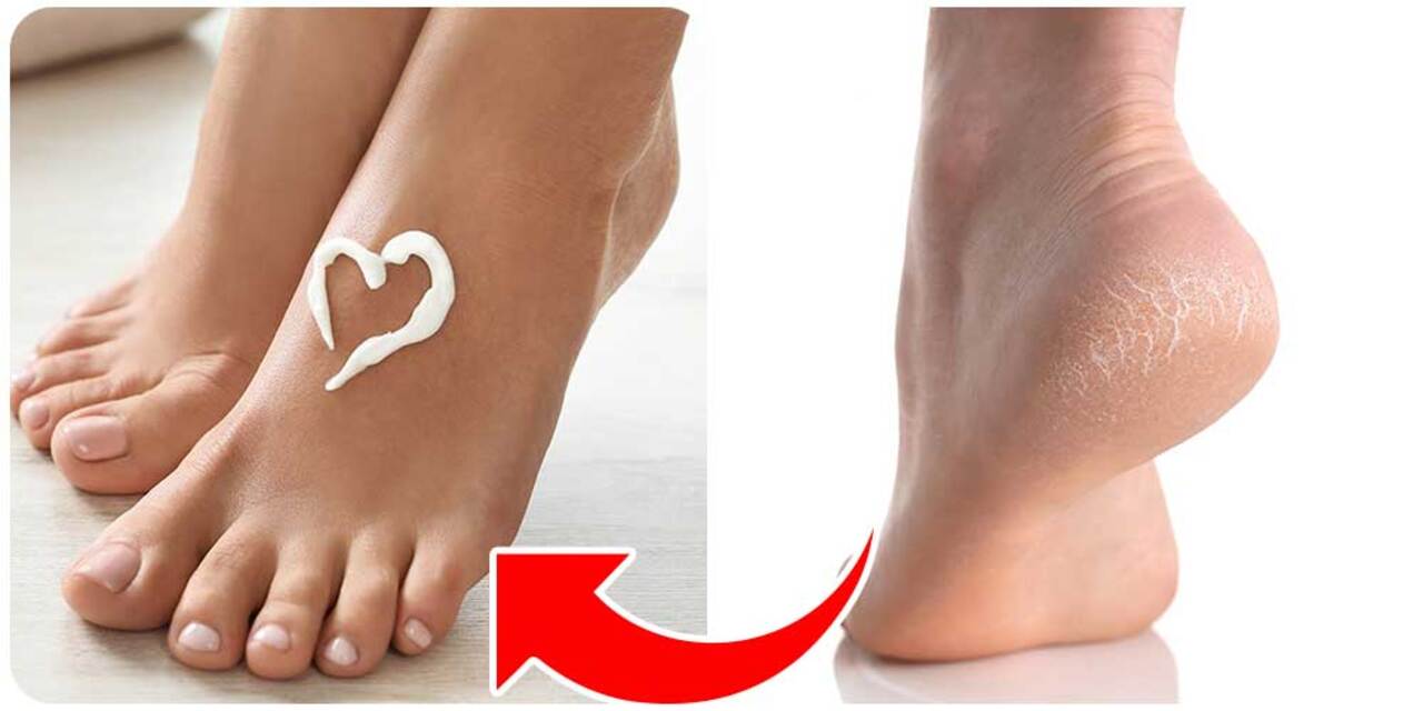 طرق علاج تشققات الكعبين