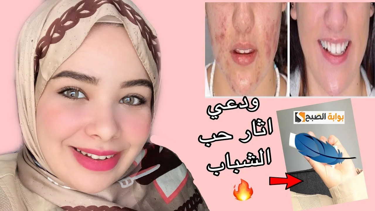 عشبة النيم لإزالة حب الشباب وتفتيح لون البشره