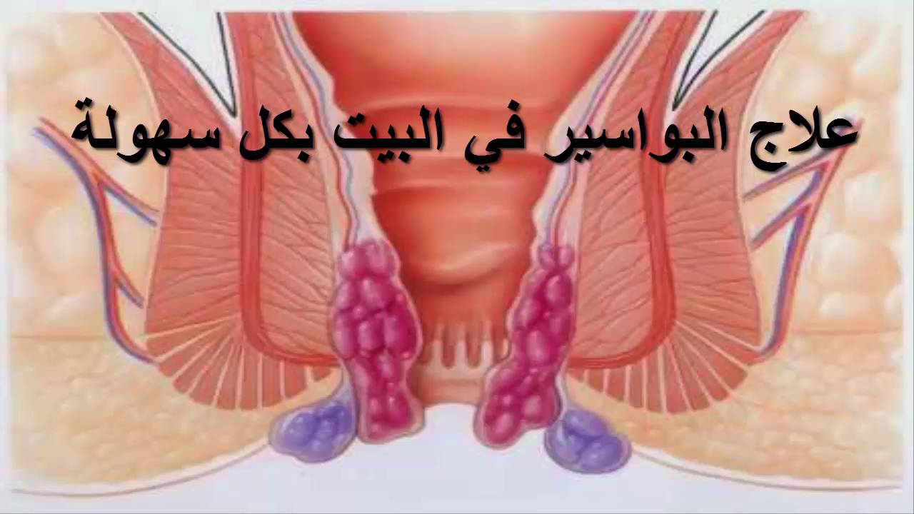 علاج البواسير في المنزل بمكونات طبعيه دون أي اثأر جانبية