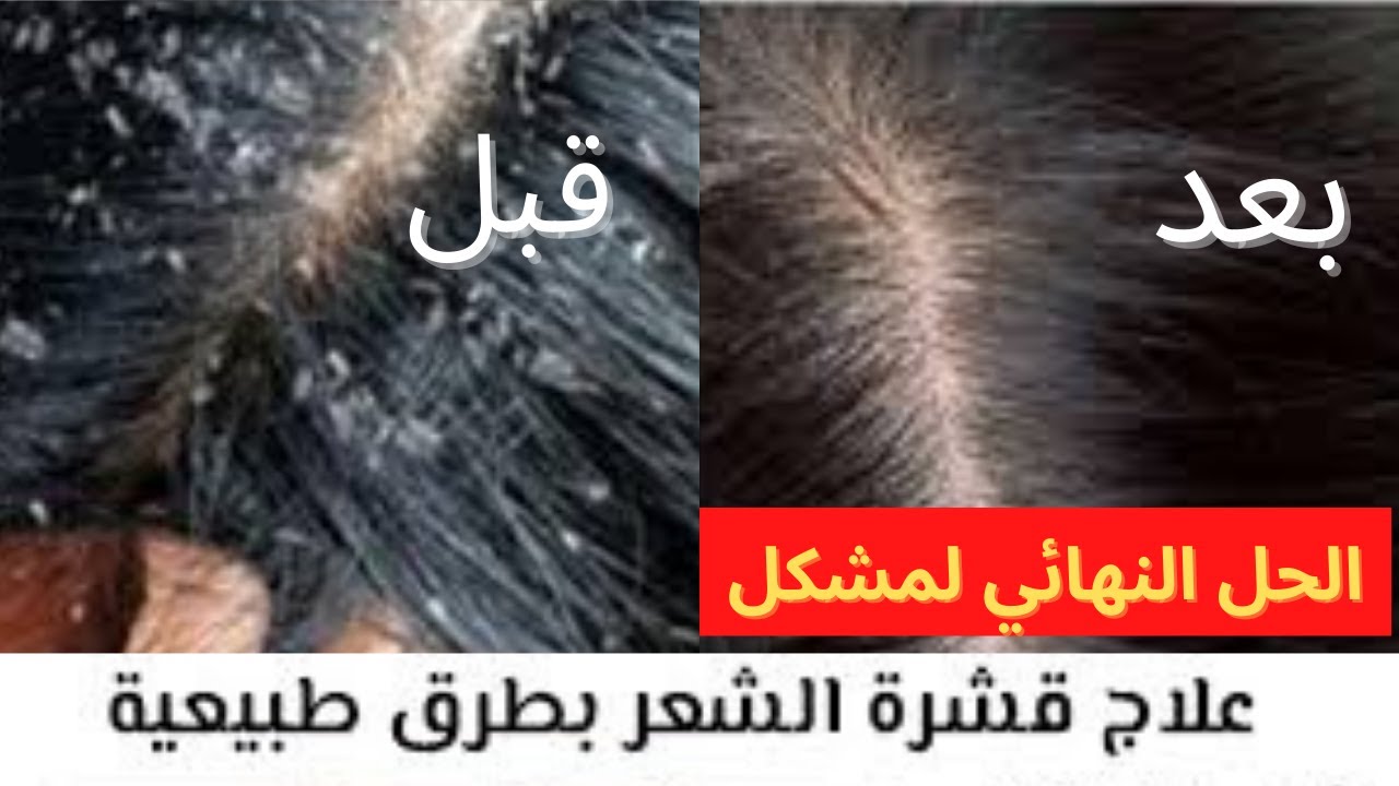 وصفات ازالة القشرة من الشعر