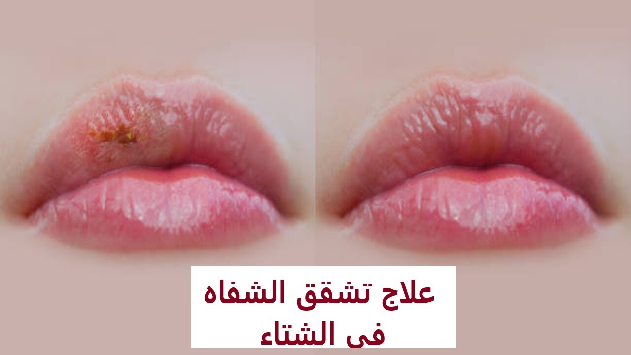وصفات سحرية بمواد طبيعية لنعومة الشفاه وترطيبها من التشقق بالشتاء