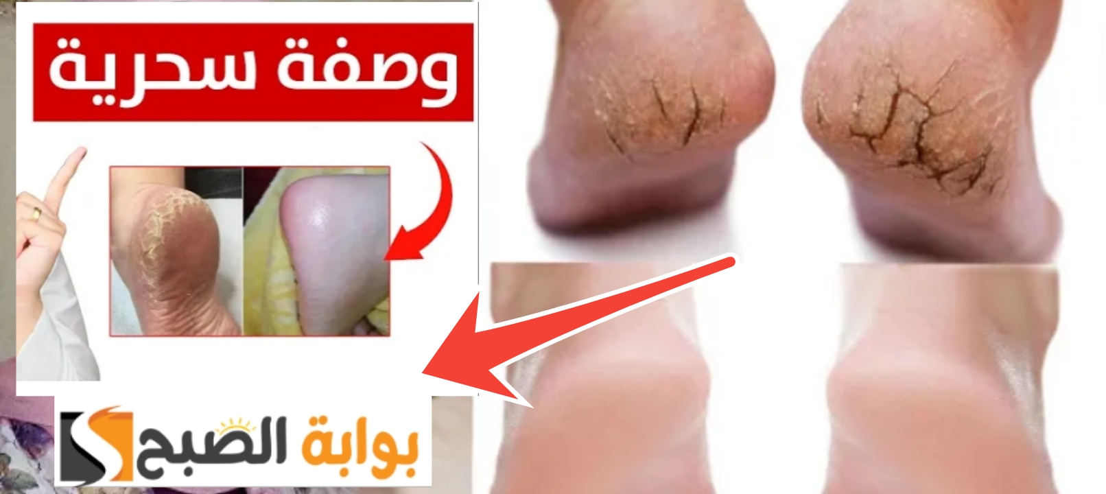 علاج تشقق القدمين 1