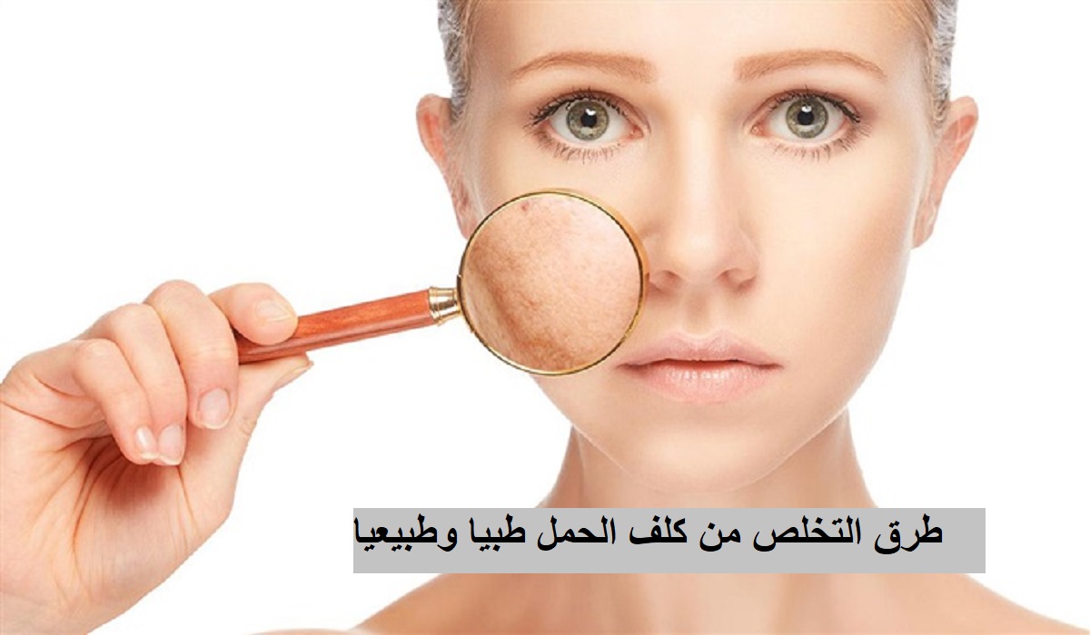 علاج كلف الحمل