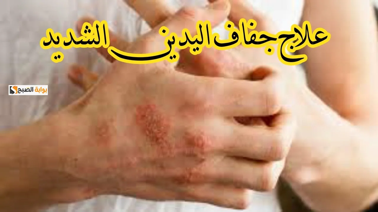مشكلة جفاف اليدين في فصل الشتاء