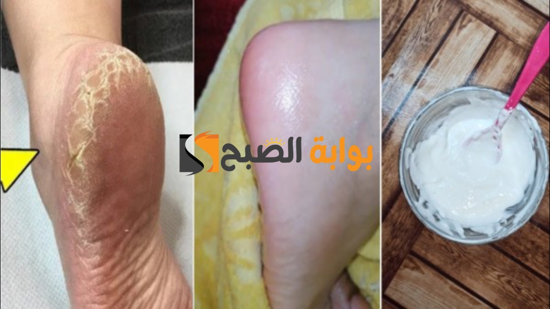 وصفة لنعومة القدمين وعلاج التشققات