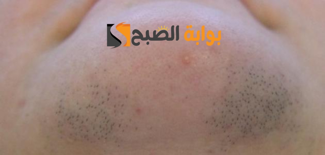 طرق ازالة الشعر