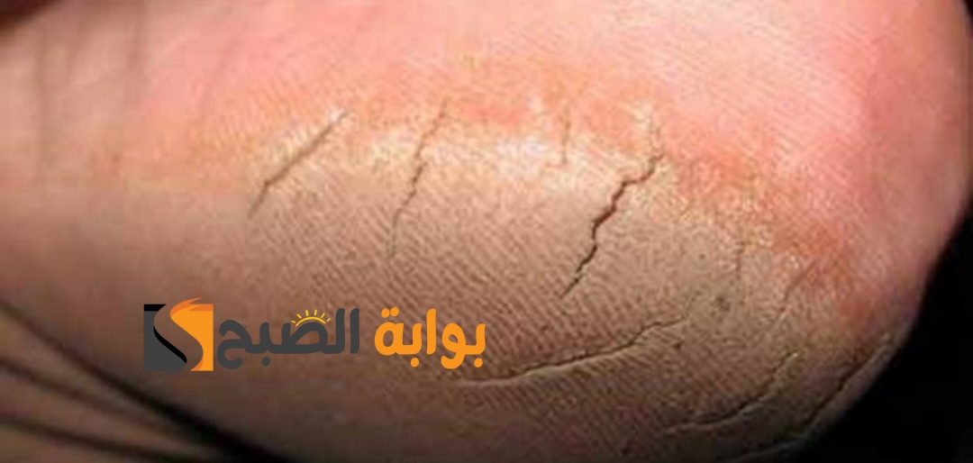 تشقق القدمين