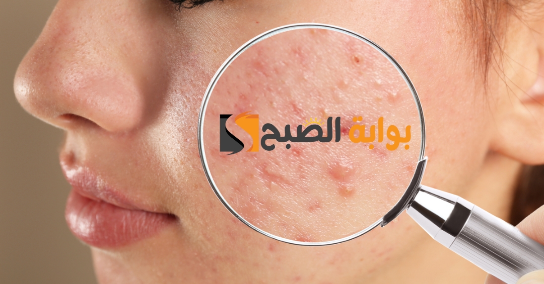 وصفة لإزالة الحبوب من الوجه في يوم واحد