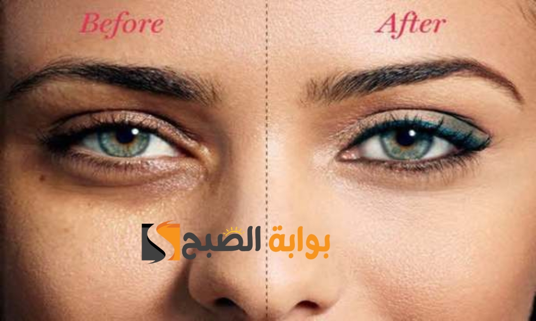 علاج الهالات السوداء
