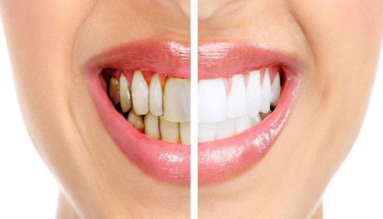 47 154813 treatment tooth