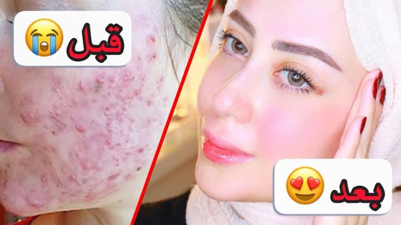 ماسك النشا للتخلص من الحبوب وآثارها