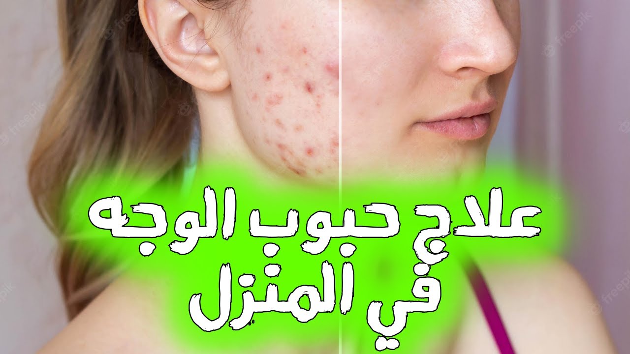 وصفة لازالة الحبوب من الوجه للبشرة الدهنية