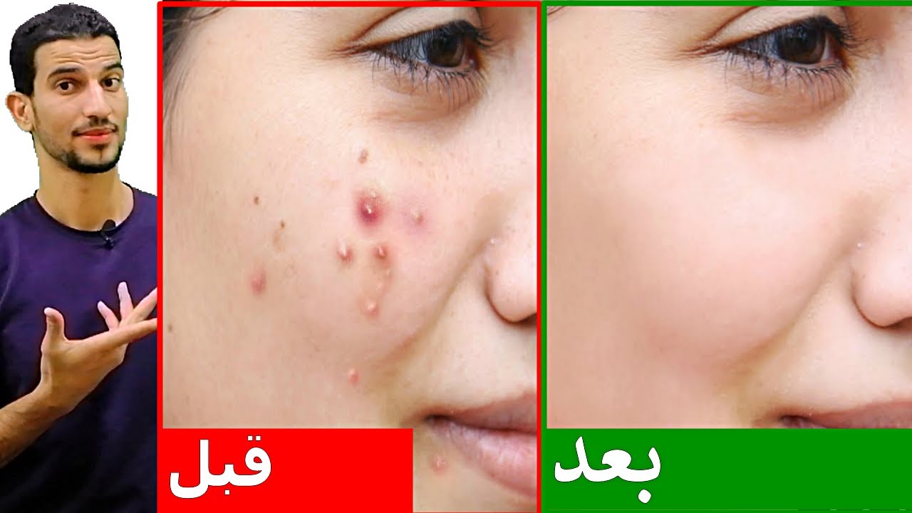علاج حب الشباب
