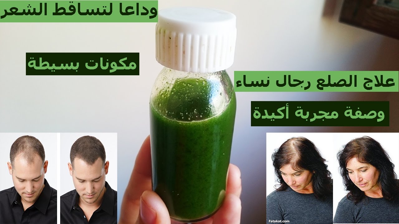 وصفة طبيعية لعلاج تساقط الشعر