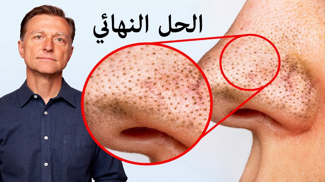 أسرع طريقة لعلاج الرؤوس السوداء