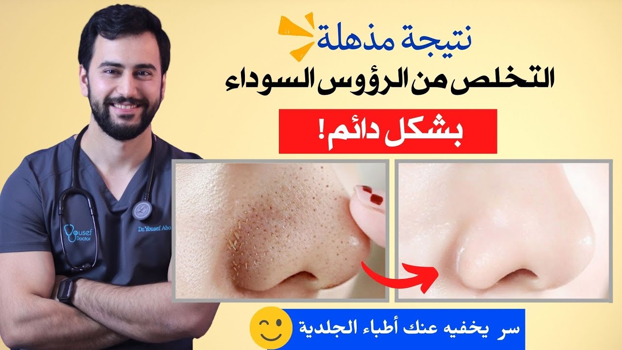 إزالة الرؤوس السوداء