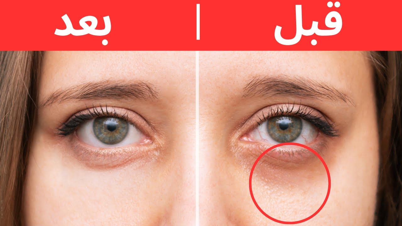 استخدام بياض البيض لعلاج انتفاخ العين