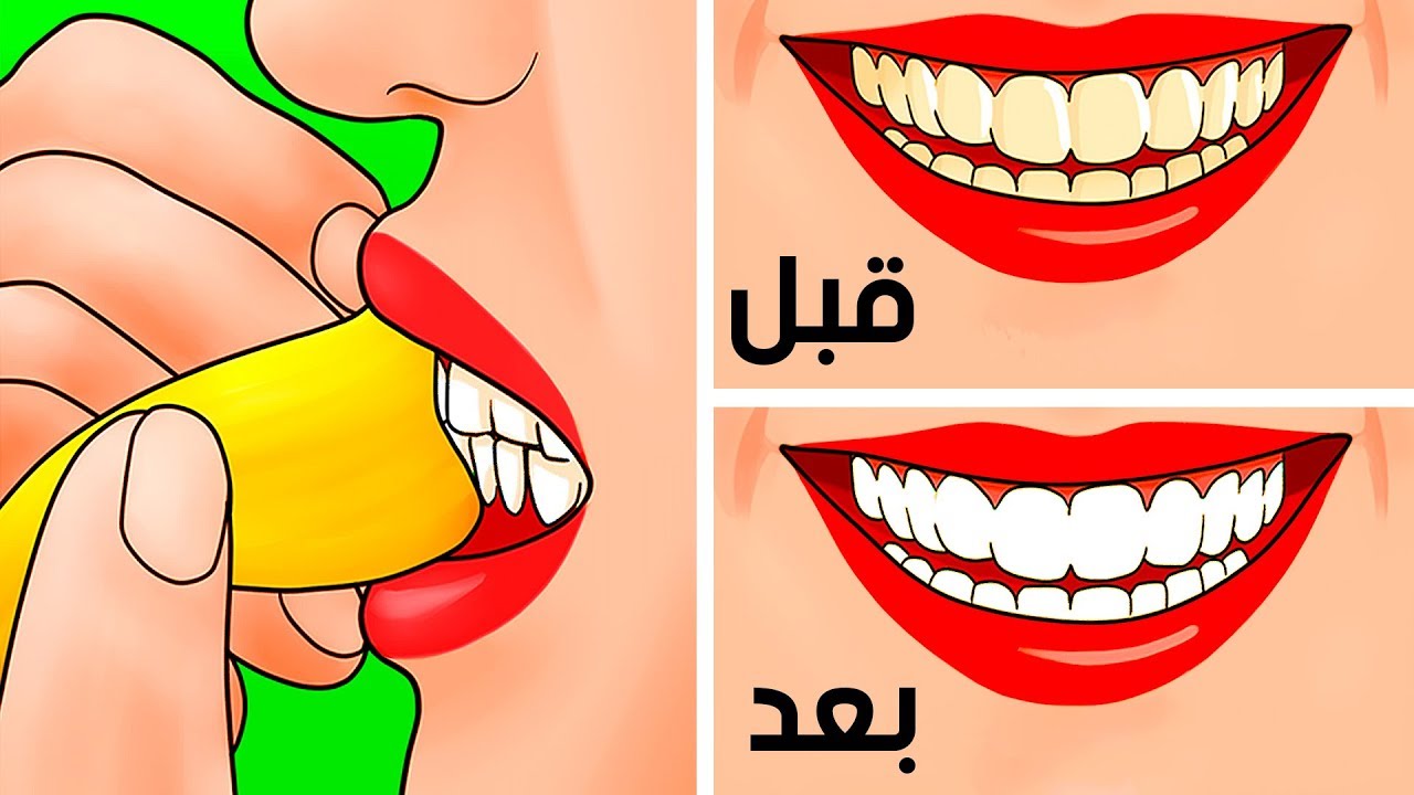 تبييض الأسنان باستخدام قشر الموز