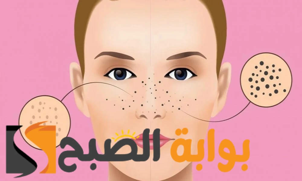 تنظيف الوجه والأنف من الرؤوس السوداء