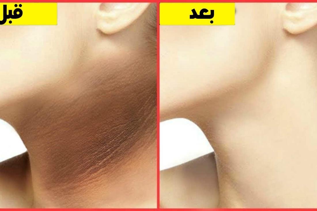 خلطة تبييض سواد الرقبة