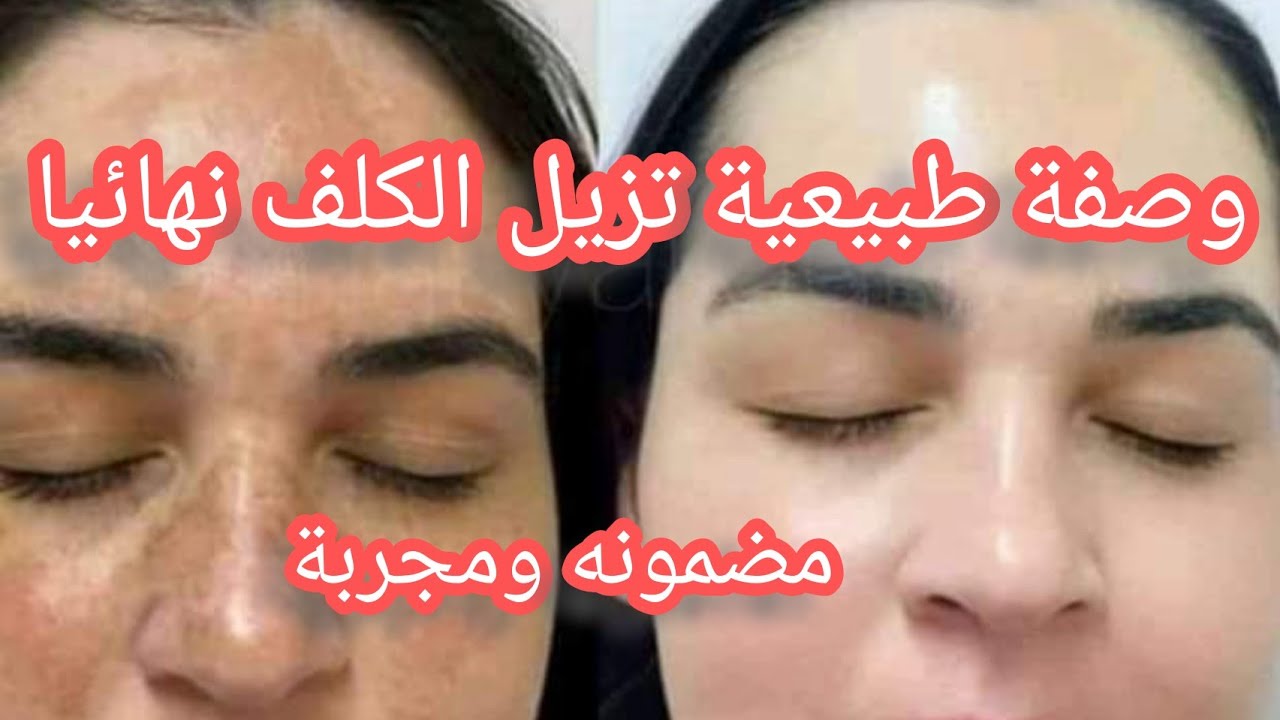 وصفات طبيعية لإزالة الكلف