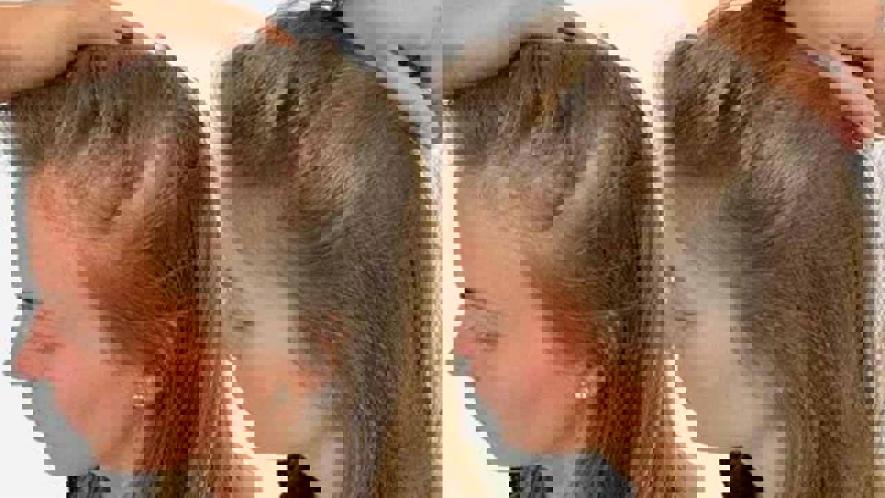 وصفات طبيعية لعلاج تساقط الشعر
