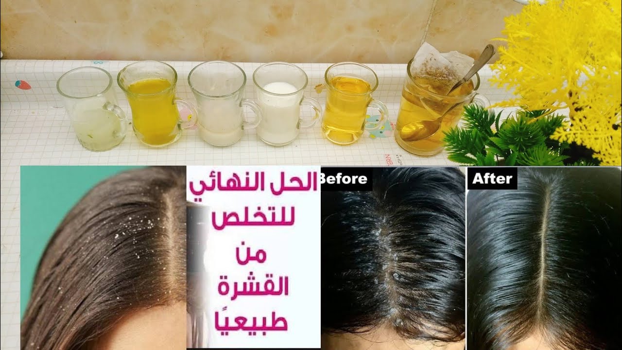 وصفات طبيعية لقشرة الشعر