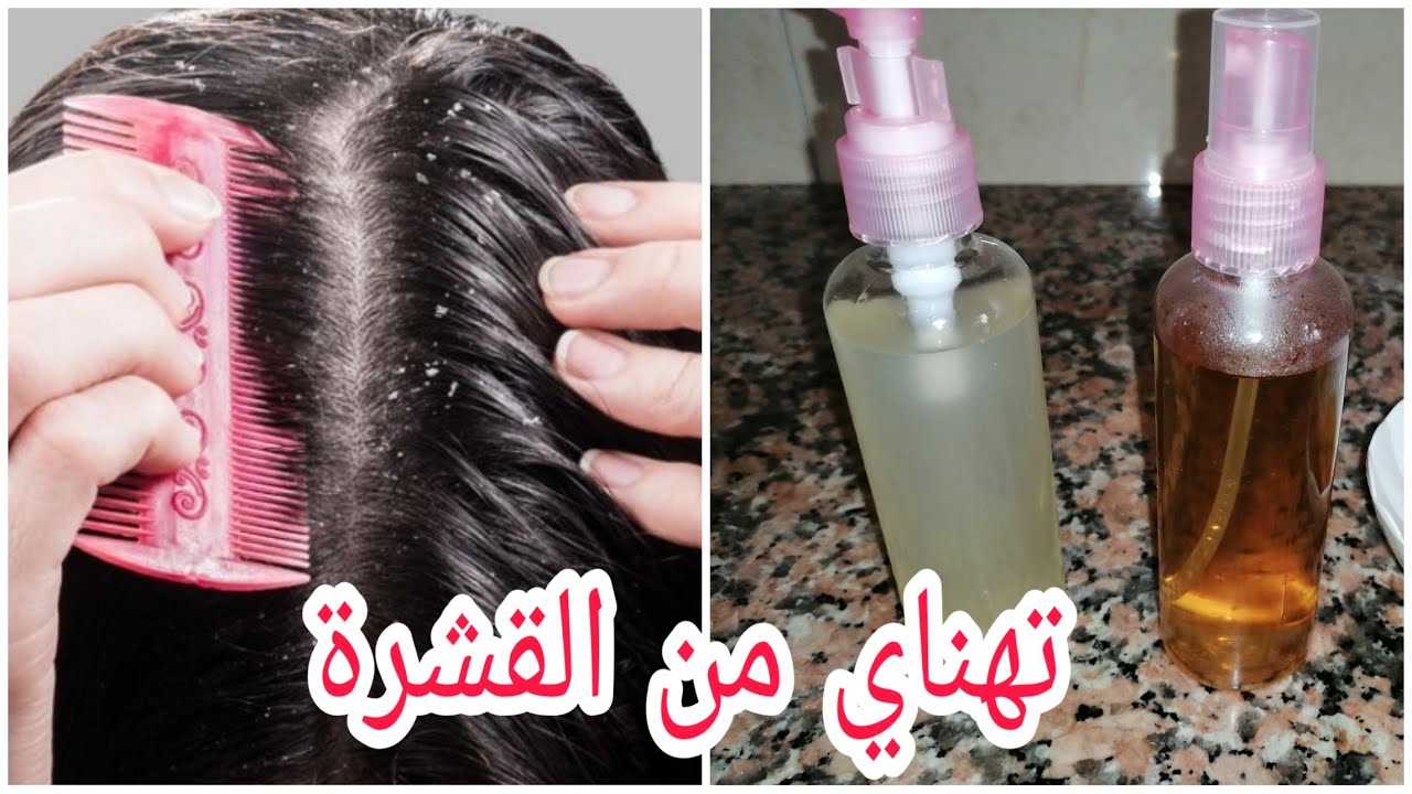 وصفات طبيعية للقشرة وتساقط الشعر