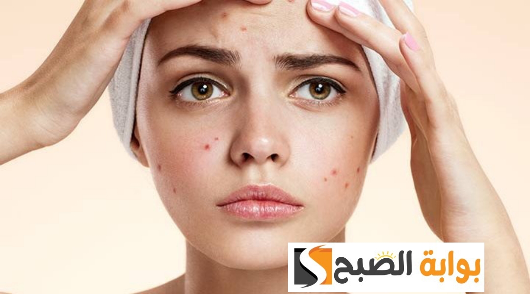 وصفة لإزالة حبوب الوجه وصفة لإزالة حبوب الأنف
