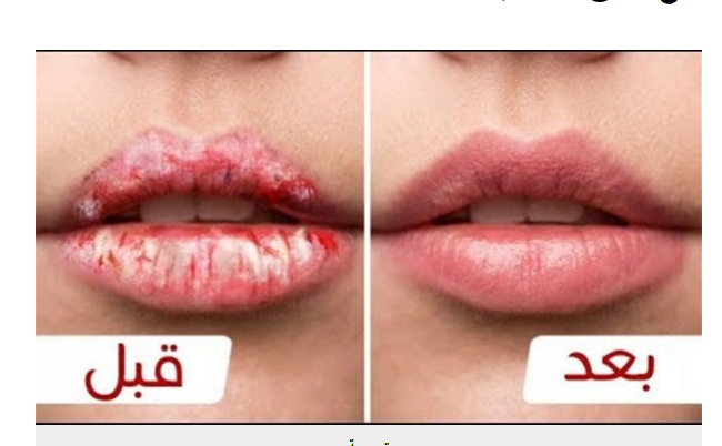 وصفات طبيعية للتخلص من تشقق وجفاف الشفايف