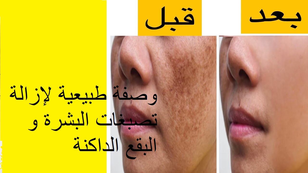 اقوي وصفة للقضاء على التصبغات