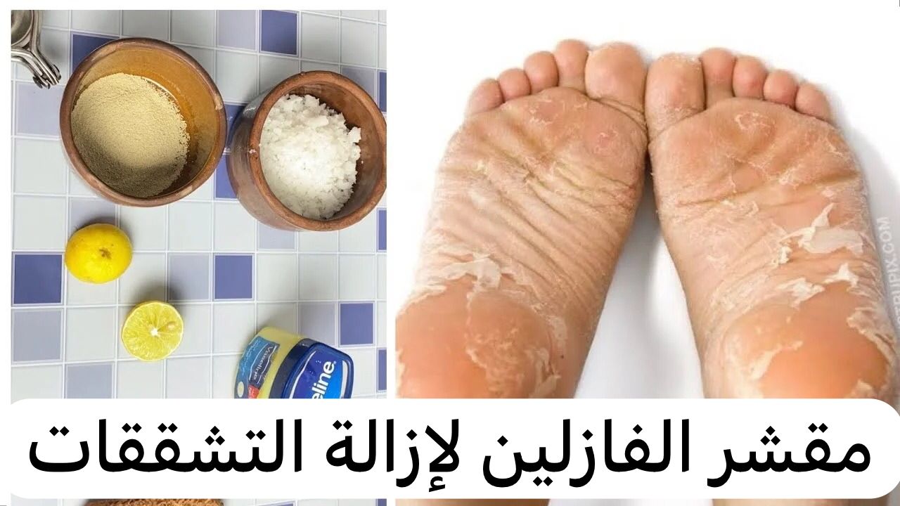 استخدام الفازلين في التخلص من تشققات القدمين