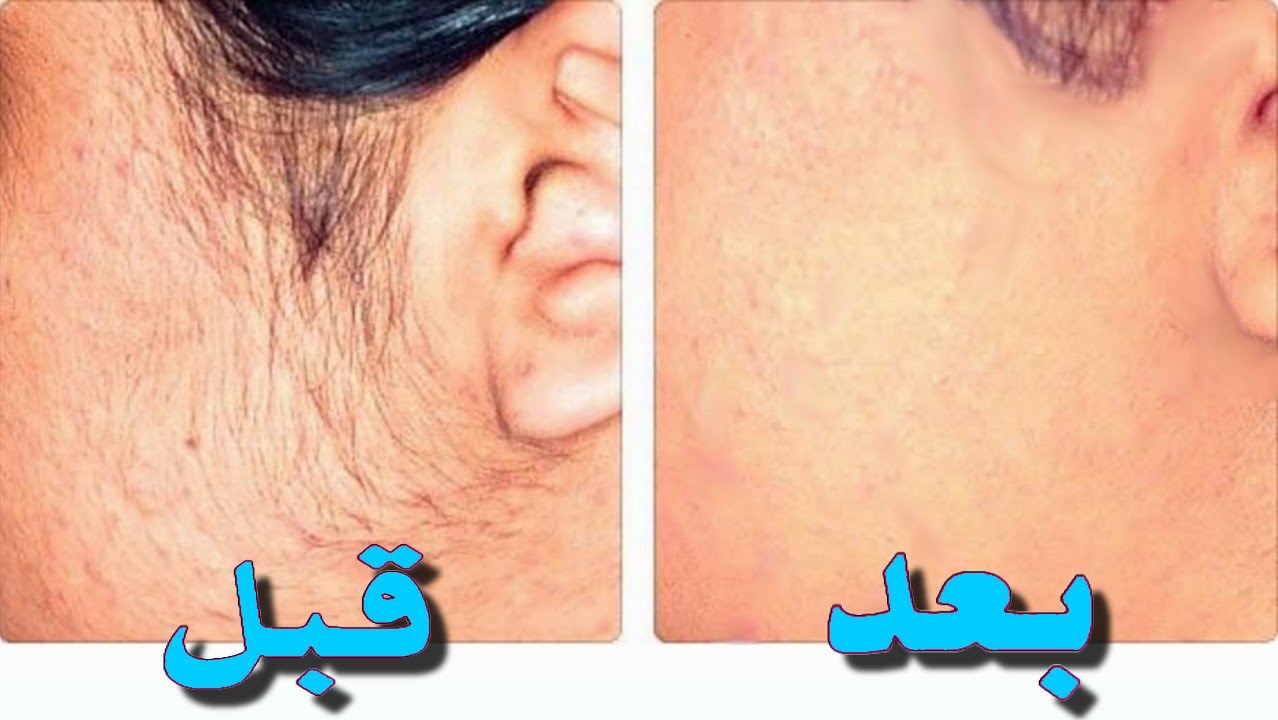 التخلص من الشعر الزائد