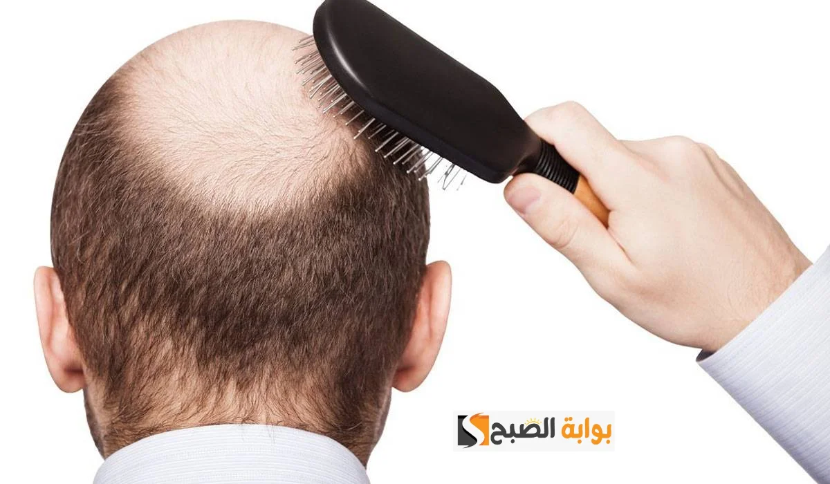 القضاء على تساقط الشعر