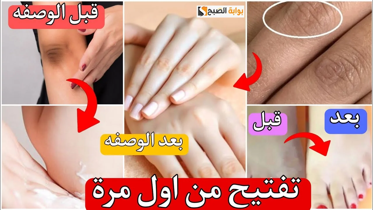 تبيض اليدين والقدمين