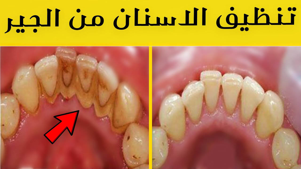 تنظيف الجير من الاسنان فى المنزل