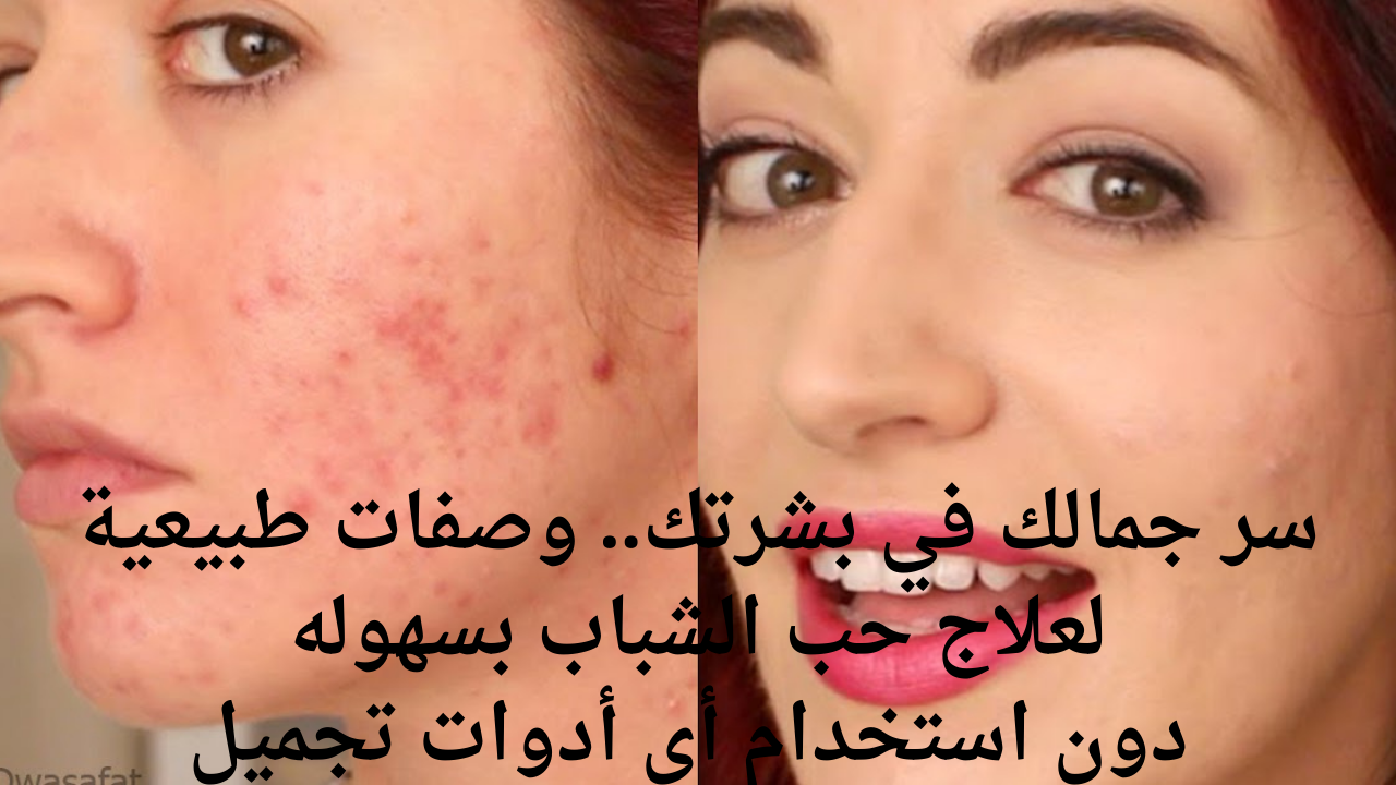 سر جمالك في بشرتك.. وصفات طبيعية لعلاج حب الشباب بسهوله دون استخدام أي أدوات تجميل