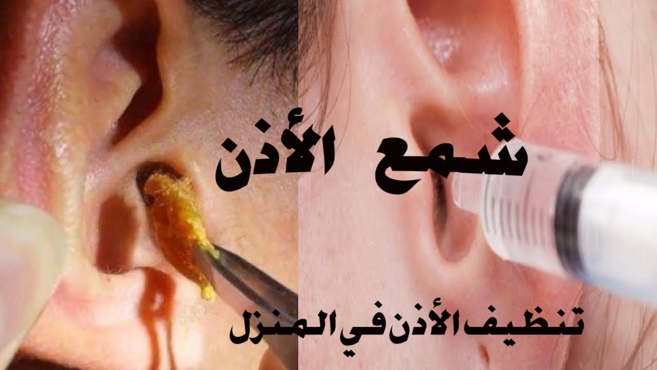 طرق آمنة في للتخلص من شمع الأذن