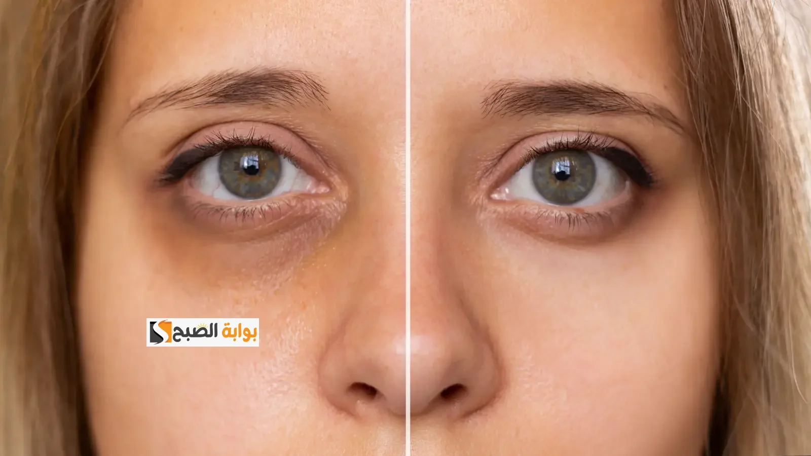 وصفات طبيعية لإزالة الهالات السوداء