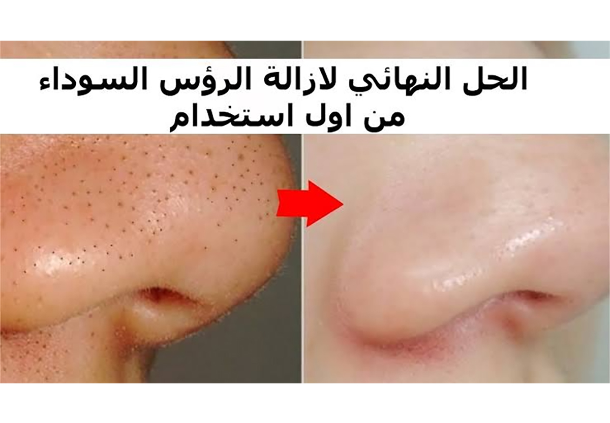 كيفية التخلص من الرؤوس السوداء من الأنف؟